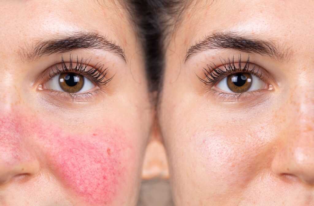 A before and after treatment comparison image of a woman's face with rosacea on the left side and clear skin on the right
