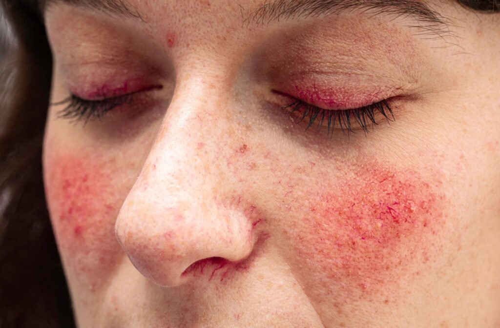 A person's face up close, eyes closed, with mild rosacea on the cheeks and lids.