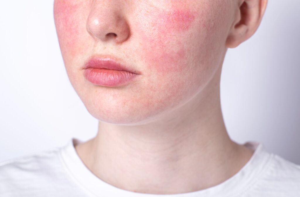 Close up of a persons face who has rosacea on their cheeks
